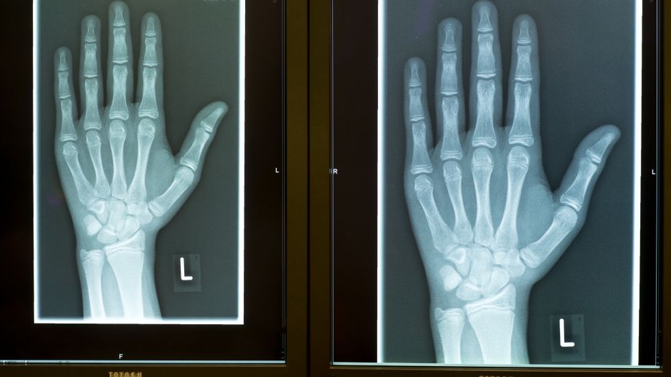 Röntgenbilder zeigen die linke Hand eines 15-Jährigen